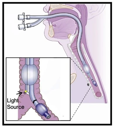 Pediatryske dûbele lumen buis